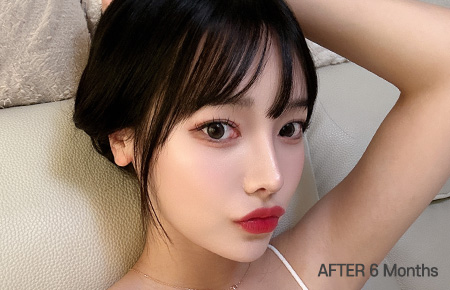 facial contour sec03 bottom after6m pc