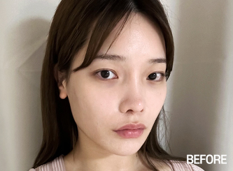 facial contour sec03 bottom before1 mo