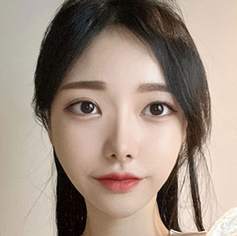 facial contour sec03 top after3 mo