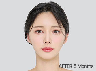 facial contour sec03 top after5m mo