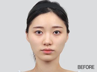 facial contour sec03 top before mo