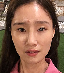 facial contour sec03 top after0 pc new