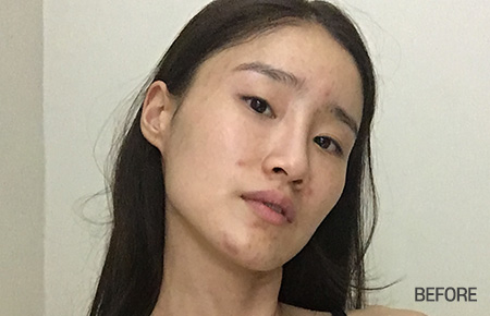 facial contour zygoma before