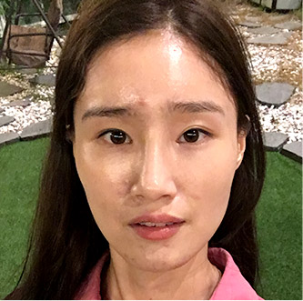 facial zygoma top after0 mo