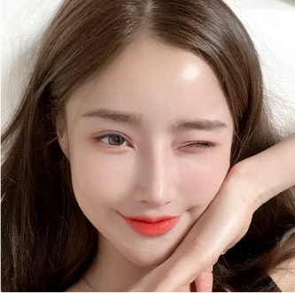 facial zygoma top after3 mo