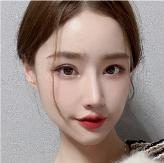 facial zygoma top after5 mo