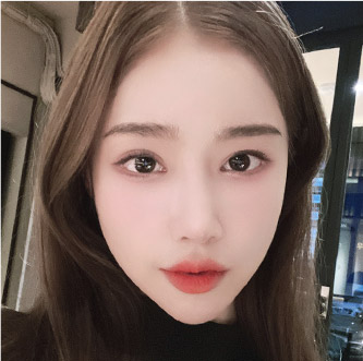 facial zygoma top after8 mo