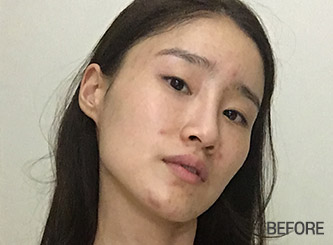 facial zygoma top before mo