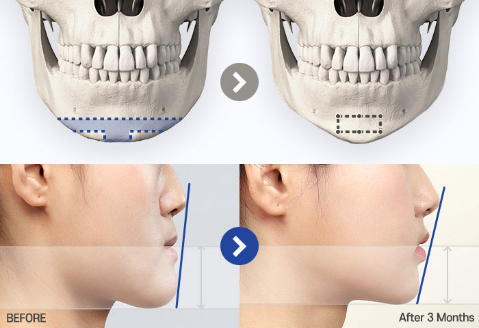 genioplasty tab 02 mo