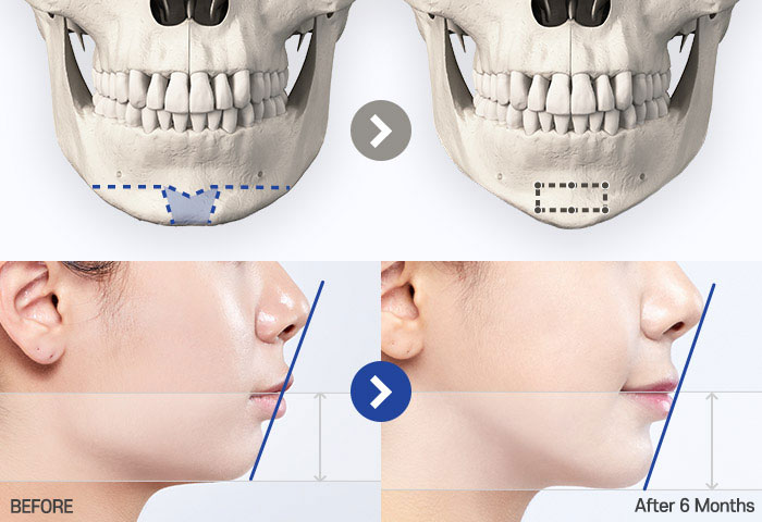 genioplasty tab 03 mo
