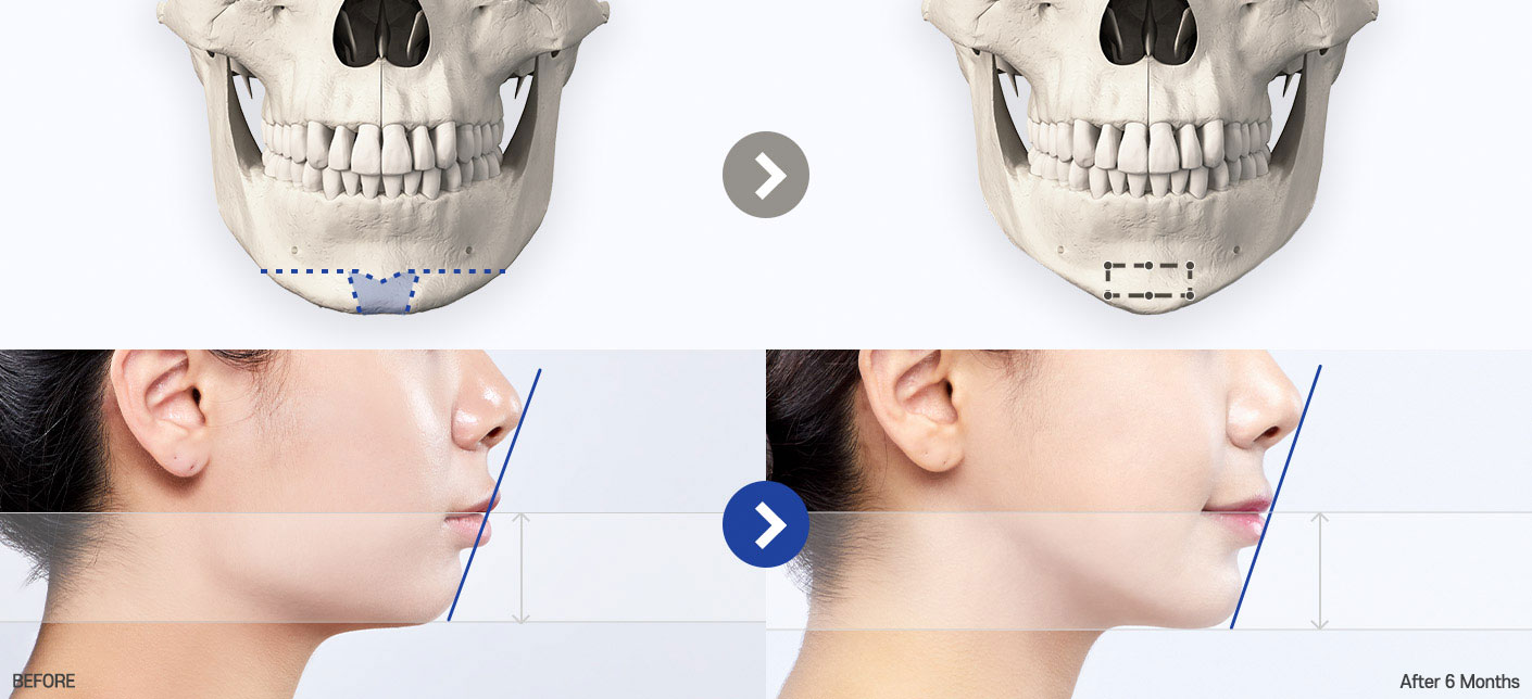 genioplasty tab 03 pc