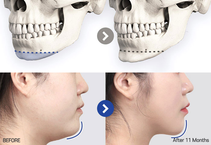 genioplasty tab 04 mo