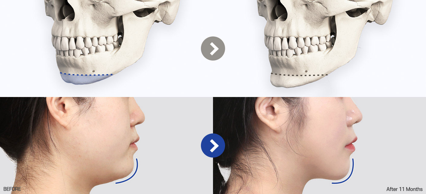 genioplasty tab 04 pc