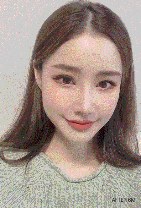gif model zygoma