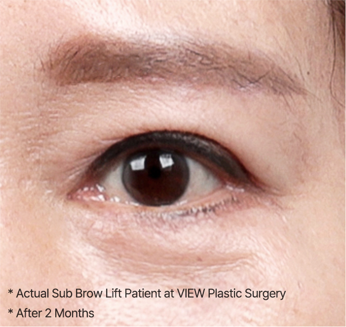 Sub Brow Lift 34 browlift slide 03 mo
