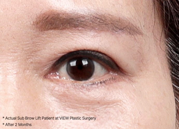 Sub Brow Lift 33 browlift slide 03 pc