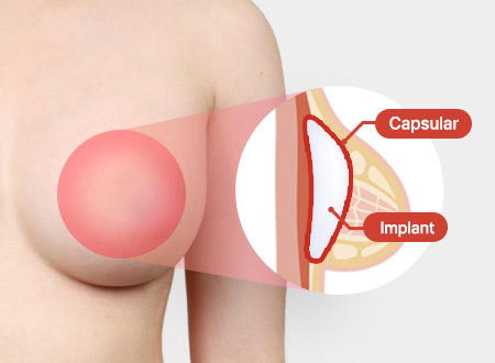 01. 구형구축이 생긴 경우