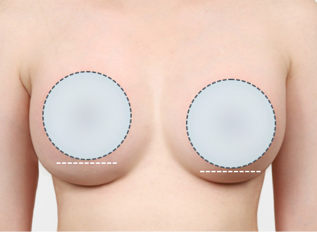 02. 양쪽 가슴이 비대칭인 경우