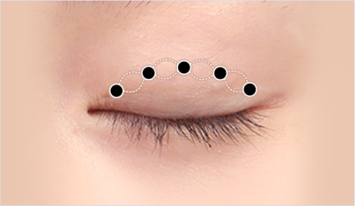 Non-Incisional Ptosis Correction