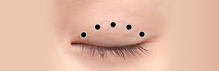 Non-Incisional Ptosis Correction