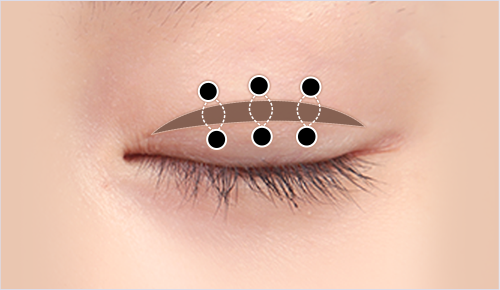 Incisional Ptosis Correction