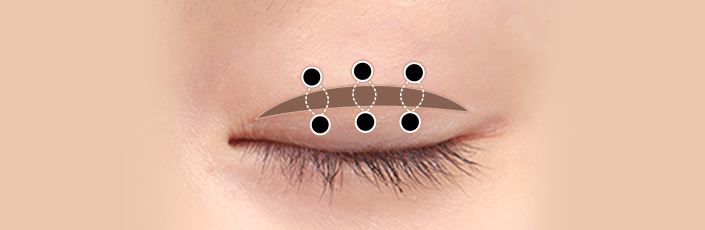 Incisional Ptosis Correction