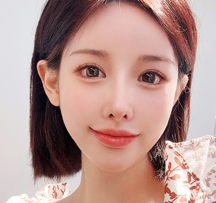 img canthoplasty2 mo