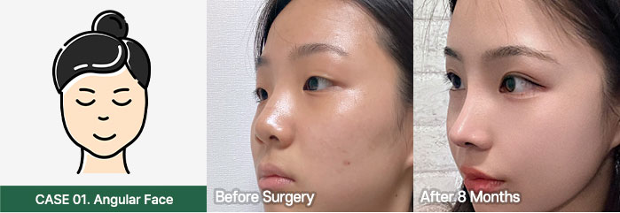 nose bfaf slide 01 mo