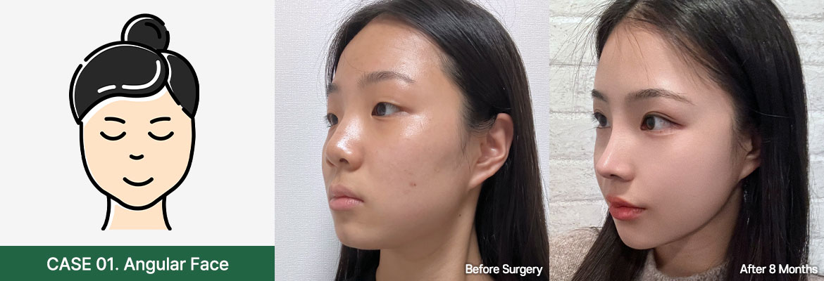 nose bfaf slide 01 pc