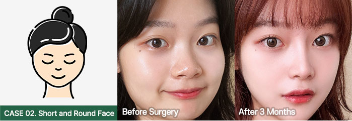 nose bfaf slide 02 mo