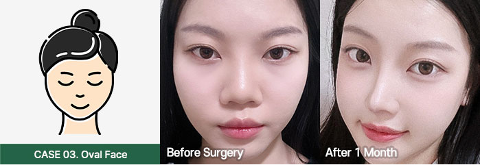 nose bfaf slide 03 mo