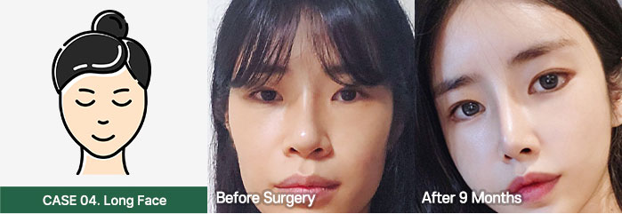 nose bfaf slide 04 mo