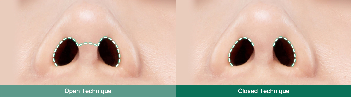 nose case 01 method2 pc