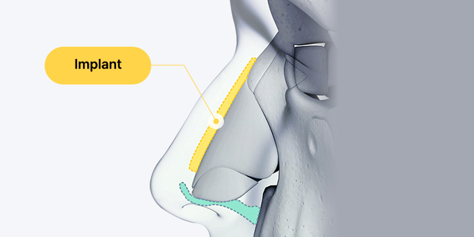 nose case 01 method 01