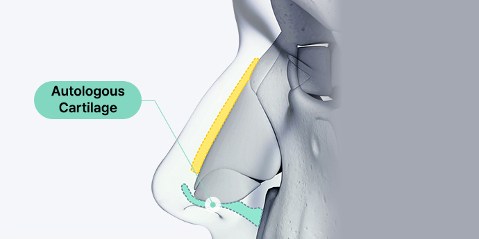 nose case 01 method 02