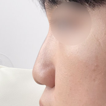 nose case 01 point 03