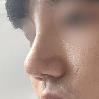 nose case 01 point 04