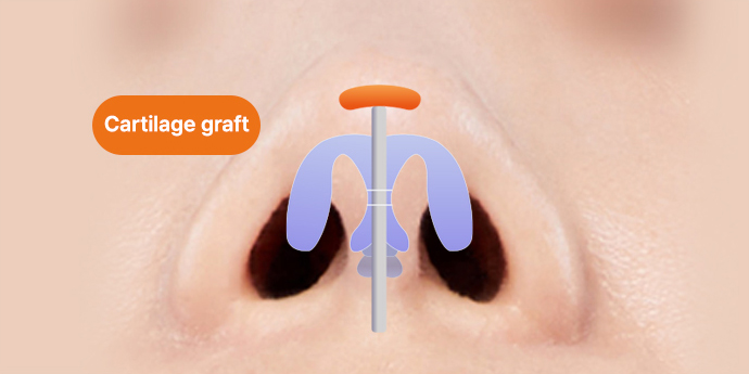 nose case 02 method 01