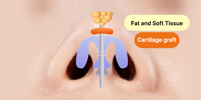 nose case 02 method 02