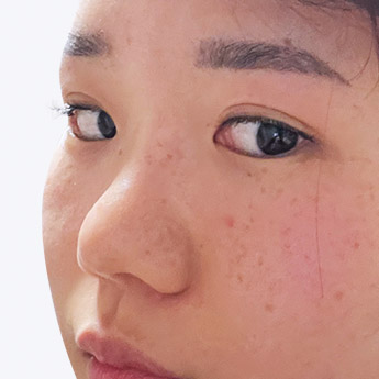 nose case 02 point 03