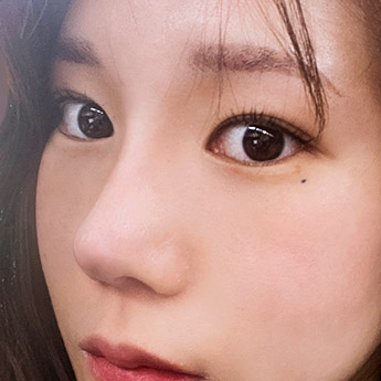 nose case 02 point 04