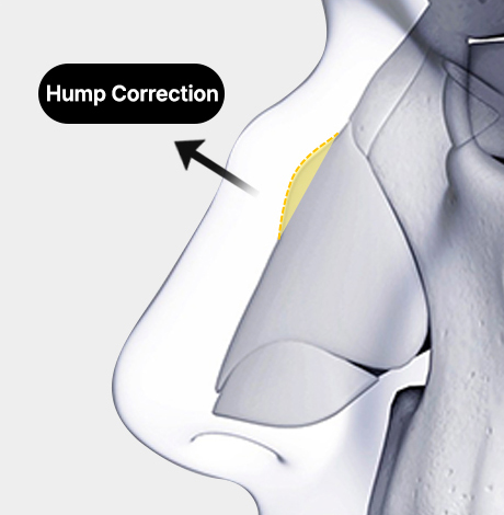 nose case 03 method 01
