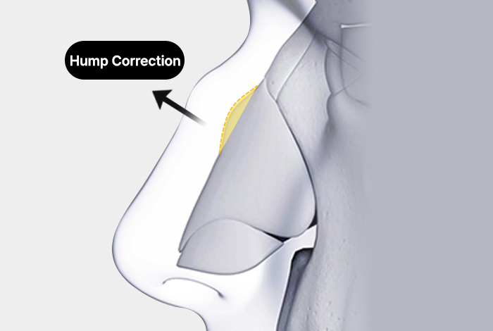 nose case 03 method 01 mo