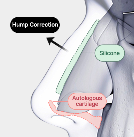 nose case 03 method 02