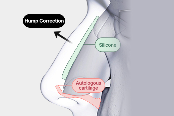 nose case 03 method 02 mo