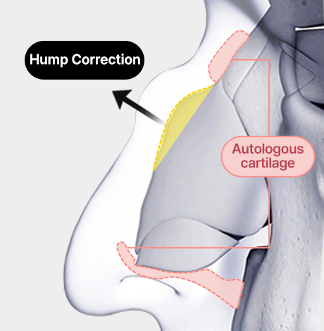 nose case 03 method 03