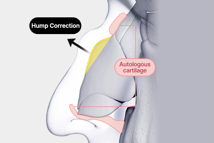 nose case 03 method 03 mo