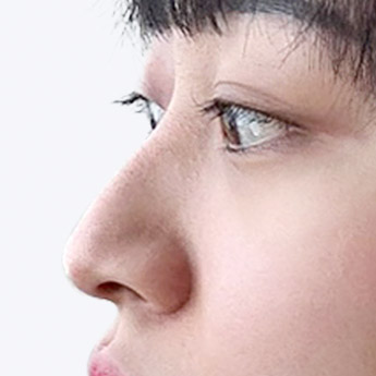 nose case 03 point 01