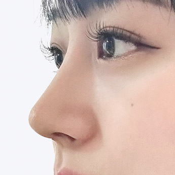 nose case 03 point 02