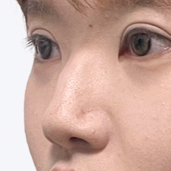 nose case 03 point 03